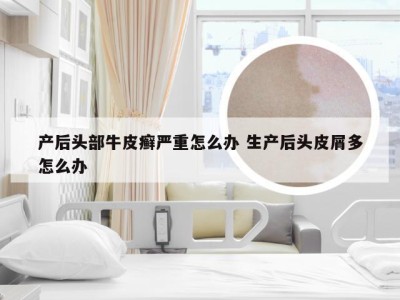 产后头部牛皮癣严重怎么办 生产后头皮屑多怎么办