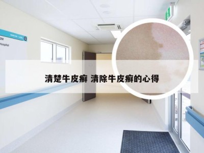清楚牛皮癣 清除牛皮癣的心得