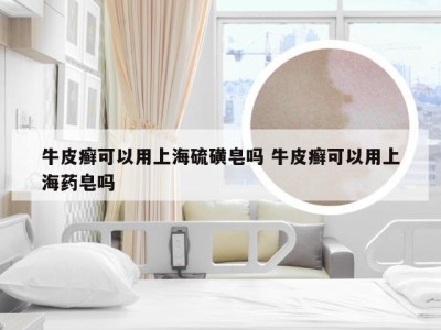 牛皮癣可以用上海硫磺皂吗 牛皮癣可以用上海药皂吗