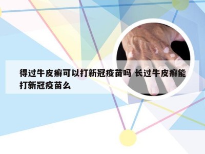 得过牛皮癣可以打新冠疫苗吗 长过牛皮癣能打新冠疫苗么