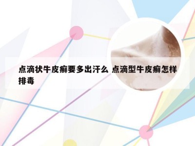 点滴状牛皮癣要多出汗么 点滴型牛皮癣怎样排毒