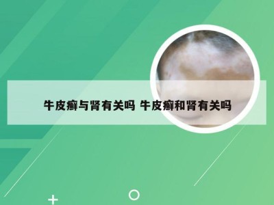 牛皮癣与肾有关吗 牛皮癣和肾有关吗