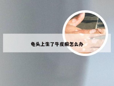 龟头上生了牛皮癣怎么办