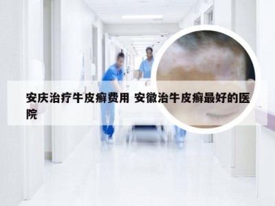 安庆治疗牛皮癣费用 安徽治牛皮癣最好的医院
