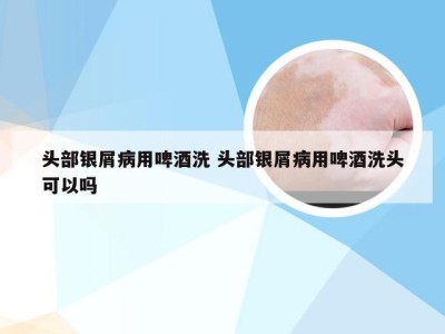 头部银屑病用啤酒洗 头部银屑病用啤酒洗头可以吗