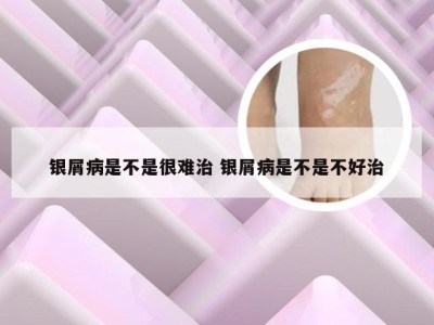 银屑病是不是很难治 银屑病是不是不好治