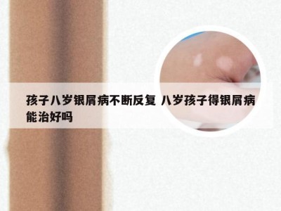 孩子八岁银屑病不断反复 八岁孩子得银屑病能治好吗