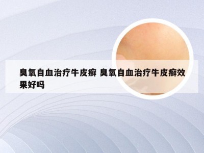 臭氧自血治疗牛皮癣 臭氧自血治疗牛皮癣效果好吗