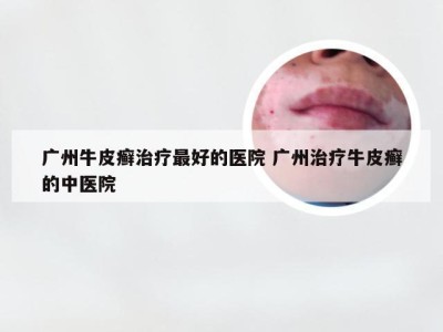 广州牛皮癣治疗最好的医院 广州治疗牛皮癣的中医院