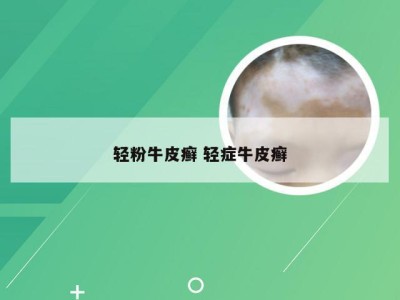 轻粉牛皮癣 轻症牛皮癣