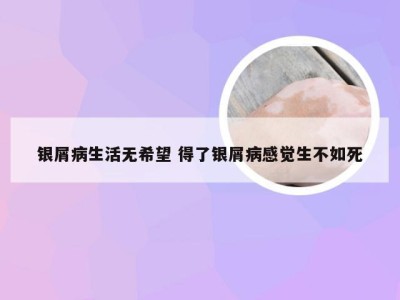 银屑病生活无希望 得了银屑病感觉生不如死