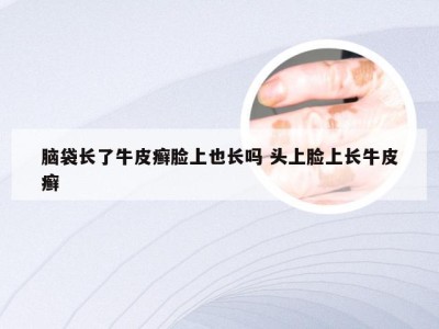 脑袋长了牛皮癣脸上也长吗 头上脸上长牛皮癣