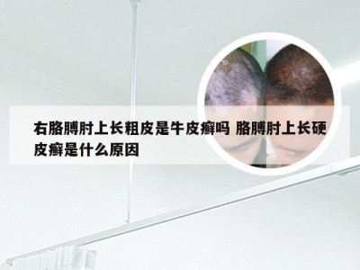 右胳膊肘上长粗皮是牛皮癣吗 胳膊肘上长硬皮癣是什么原因