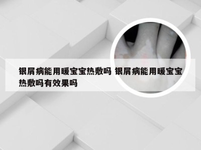 银屑病能用暖宝宝热敷吗 银屑病能用暖宝宝热敷吗有效果吗