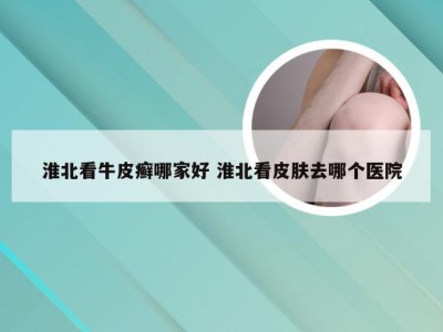 淮北看牛皮癣哪家好 淮北看皮肤去哪个医院