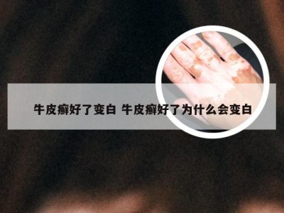 牛皮癣好了变白 牛皮癣好了为什么会变白