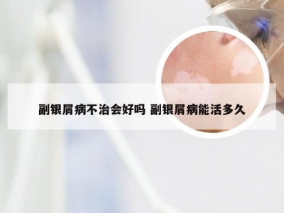副银屑病不治会好吗 副银屑病能活多久