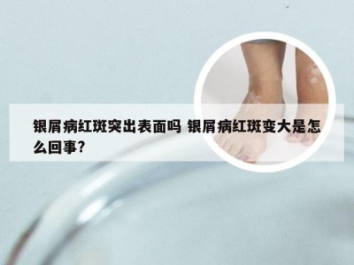 银屑病红斑突出表面吗 银屑病红斑变大是怎么回事?