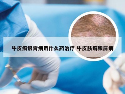 牛皮癣银霄病用什么药治疗 牛皮肤癣银屑病