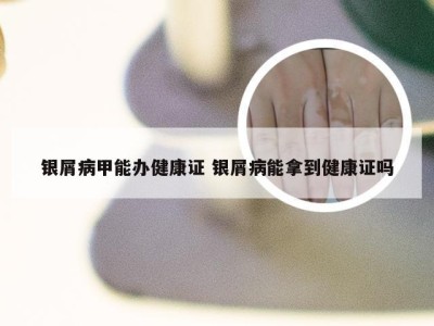 银屑病甲能办健康证 银屑病能拿到健康证吗