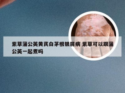 紫草蒲公英黄芪白茅根银屑病 紫草可以跟蒲公英一起煮吗