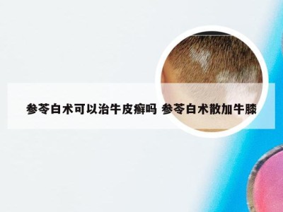 参苓白术可以治牛皮癣吗 参苓白术散加牛膝