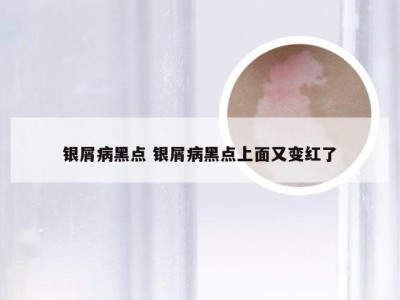 银屑病黑点 银屑病黑点上面又变红了