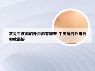 常见牛皮癣的外用药有哪些 牛皮癣的外用药哪款最好