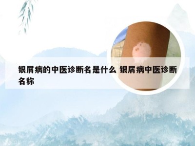 银屑病的中医诊断名是什么 银屑病中医诊断名称