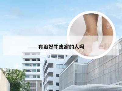 有治好牛皮癣的人吗