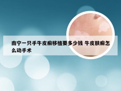南宁一只手牛皮癣移植要多少钱 牛皮肤癣怎么动手术