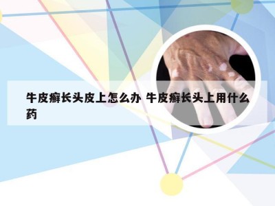 牛皮癣长头皮上怎么办 牛皮癣长头上用什么药