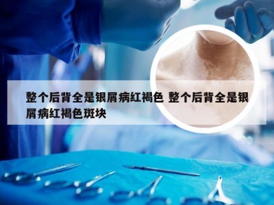 整个后背全是银屑病红褐色 整个后背全是银屑病红褐色斑块