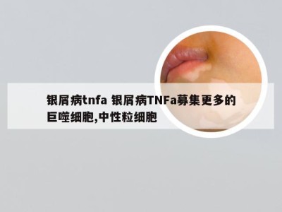 银屑病tnfa 银屑病TNFa募集更多的巨噬细胞,中性粒细胞