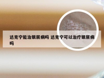 达克宁能治银屑病吗 达克宁可以治疗银屑病吗