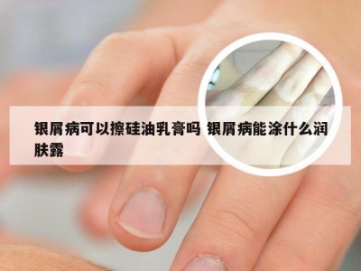 银屑病可以擦硅油乳膏吗 银屑病能涂什么润肤露