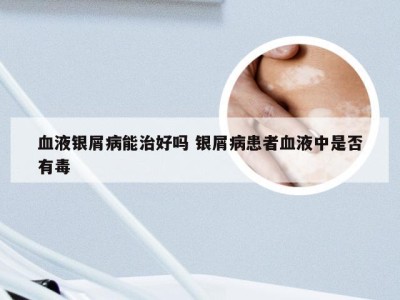 血液银屑病能治好吗 银屑病患者血液中是否有毒