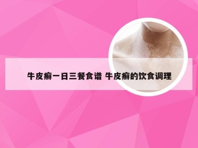 牛皮癣一日三餐食谱 牛皮癣的饮食调理