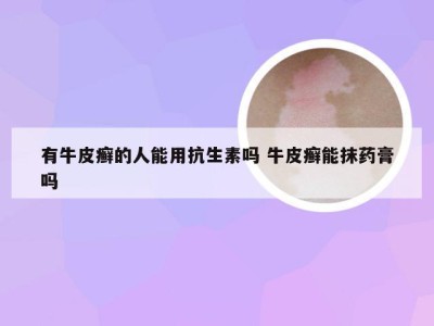 有牛皮癣的人能用抗生素吗 牛皮癣能抹药膏吗