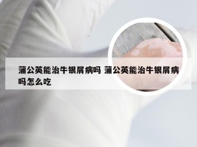 蒲公英能治牛银屑病吗 蒲公英能治牛银屑病吗怎么吃