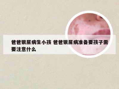 爸爸银屑病生小孩 爸爸银屑病准备要孩子需要注意什么