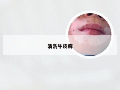 清洗牛皮癣