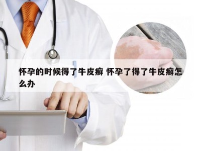 怀孕的时候得了牛皮癣 怀孕了得了牛皮癣怎么办