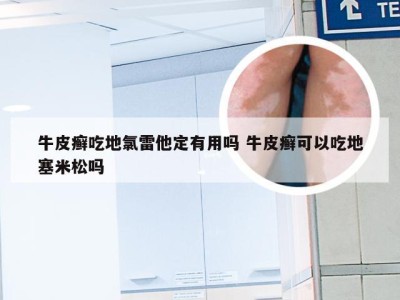 牛皮癣吃地氯雷他定有用吗 牛皮癣可以吃地塞米松吗