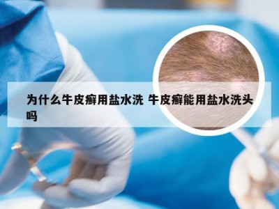 为什么牛皮癣用盐水洗 牛皮癣能用盐水洗头吗