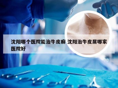 沈阳哪个医院能治牛皮癣 沈阳治牛皮屑哪家医院好