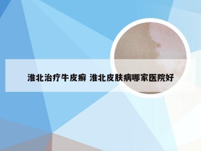 淮北治疗牛皮癣 淮北皮肤病哪家医院好