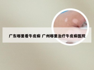 广东哪里看牛皮癣 广州哪里治疗牛皮癣医院