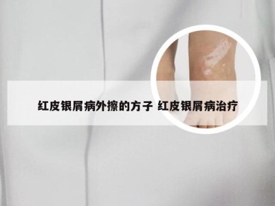 红皮银屑病外擦的方子 红皮银屑病治疗