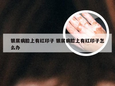 银屑病脸上有红印子 银屑病脸上有红印子怎么办